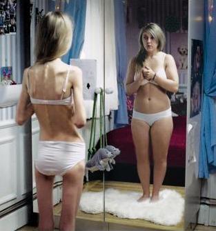 Bulimia y anorexia 